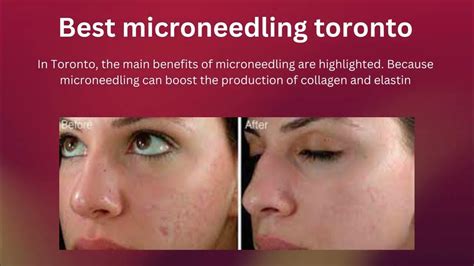 Microneedling Before And After Youtube