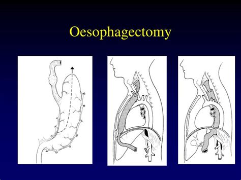 Ppt Common Thoracic Procedures Powerpoint Presentation Id520658