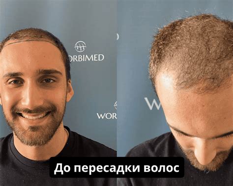 Процесс после пересадки волос | 12 месяцев шаг за шагом