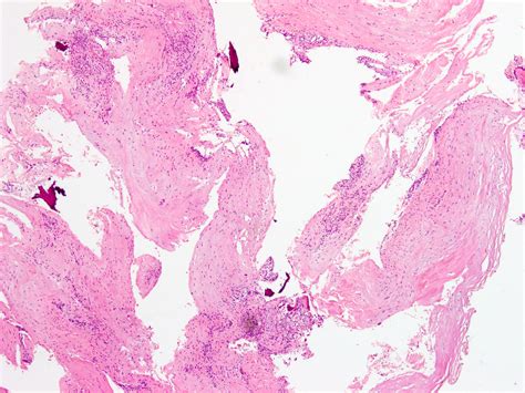 Ganglion Cyst Pathology Outlines