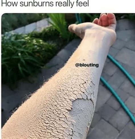 33 Funny Sunburn Memes For Those Of Us Who Don't Tan, We Roast