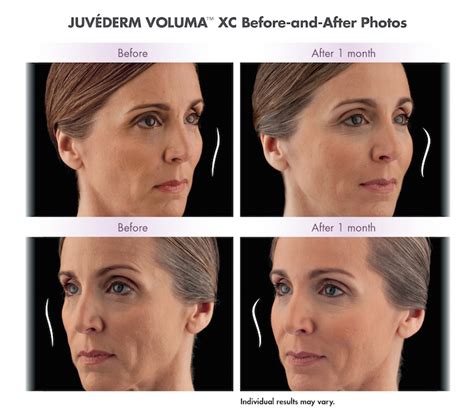 Juvederm Voluma In New Jersey The Godek Center