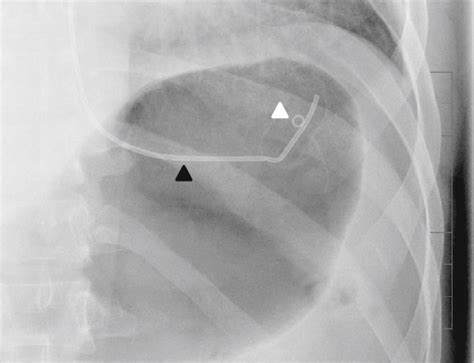 X Ray Of Elipse After It Is Swallowed But Before It Is Filled The