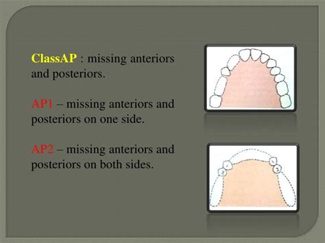 Classification Of Rpd