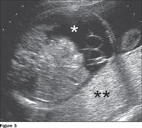 Figure 2 From Prenatal Sonographic Diagnosis Of Fetal Cardiac