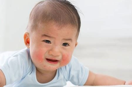 Baby Acne vs Eczema: What Are The Differences Between The Two