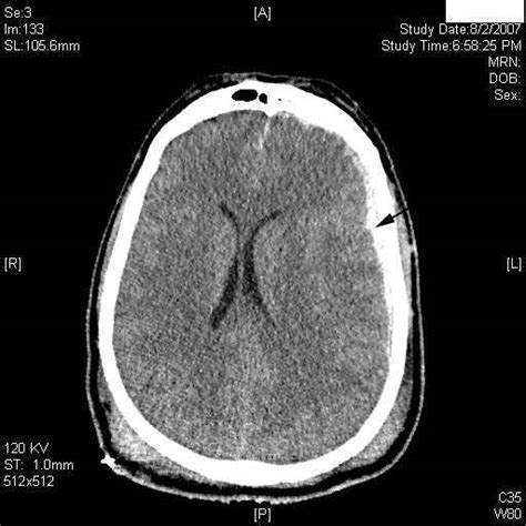 Cedera Otak Traumatik Patofisiologi Diagnosis Penatalaksanaan