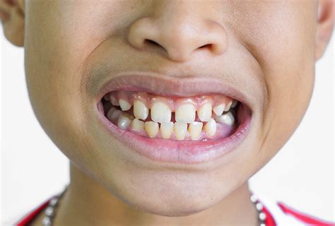 What Causes Gap Teeth and Can You Create a Gap?