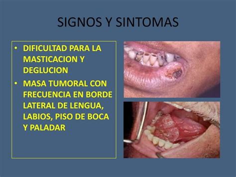 Tumores Benignos Y Malignos De Cavidad Oral Ppt