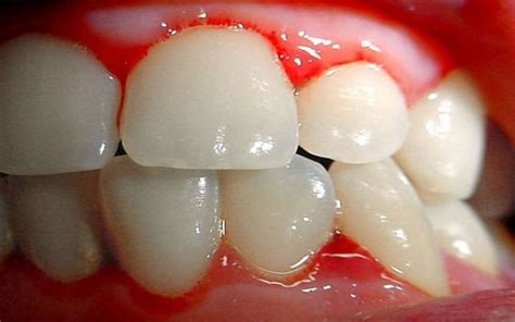 Gingivitis En El Embarazo