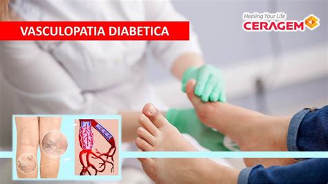 Vasculopatia Diabetica Youtube