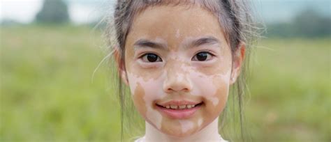 What to Know About Vitiligo in Children | UPMC HealthBeat