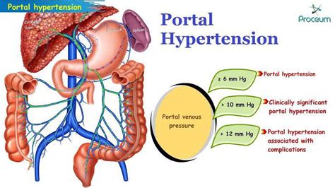 Treatment Of Portal Hypertension Medizzy