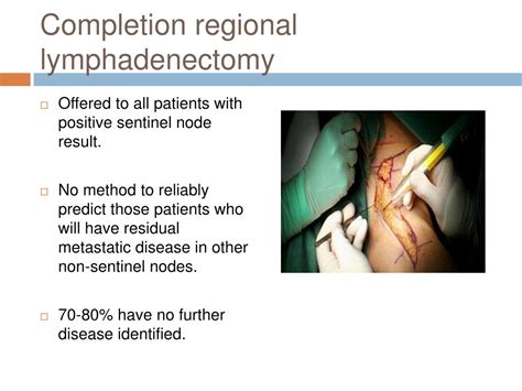 PPT Sentinel Lymph Node Biopsy In Melanoma PowerPoint Presentation