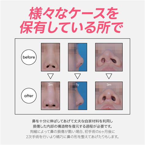 鼻手術後の拘縮現象 原因と症状によって Kobijou Jpのブログ