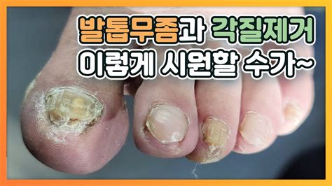 발톱무좀과 각질제거 이렇게 시원할 수가~ Youtube