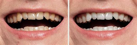 Before And After Teeth Whitening 3d Poster Effective Healthy Concept ...