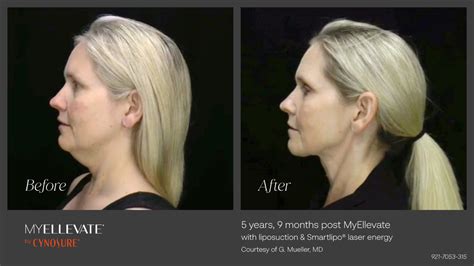 Minimally Invasive Neck Lifts With Myellevate St Louis Lipo