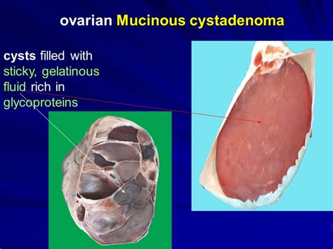 How Dermoid Cysts Are Formed Dermoid Cysts Formation Symptoms