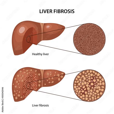 Vecteur Stock Liver Fibrosis Histology Of The Healthy And Fibrous