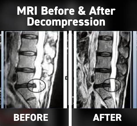 Non Surgical Spinal Decompression In Dublin Fast Pain Relief