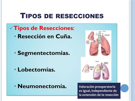 PPT Evaluación preoperatoria para cirugía de resección pulmonar