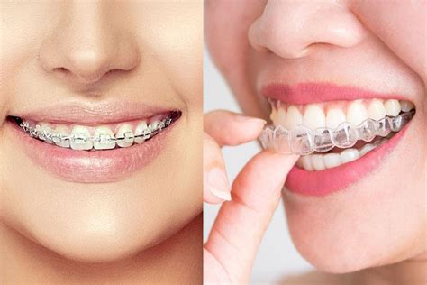 Invisalign Braces Cost In Dubai Smartsmiledc