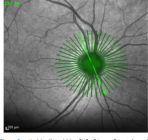 Figure From Une Nouvelle Analyse De Lanneau Neuro R Tinien En