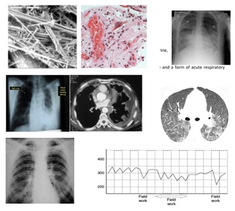 Cardiorespiratory- Lung disease Flashcards | Quizlet