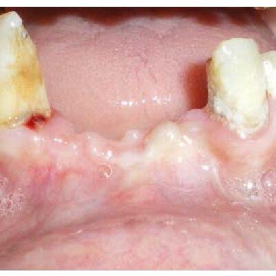 Showing Shortened Vestibule In Anterior Edentulous Site And Tendency