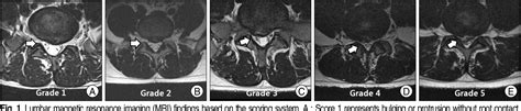 Figure 1 From Comparative Study Of Lumbar Magnetic Resonance Imaging