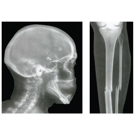 Broken Bones X-Rays | lupon.gov.ph