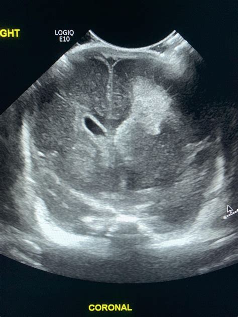 Germinal Matrix Hemorrhage