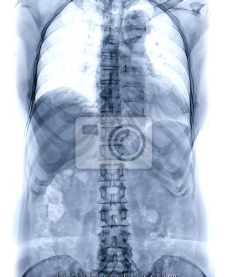 X Ray Image Of T L Spine Or Thoracolumbar Spine Ap View For Diagnosis