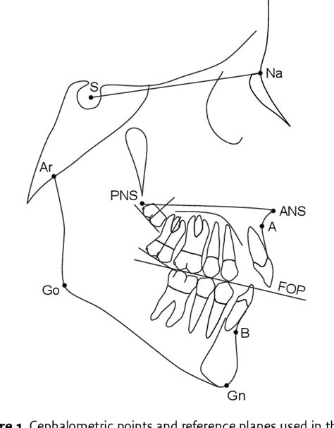 Figure 1 From Maxillary First Molar Extraction In Class Ii Malocclusion Semantic Scholar