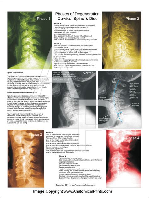 Cervical Spinal Degeneration Poster