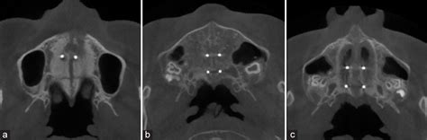 Changes In The Nasal And Pharyngeal Airway Volume With Miniscrew