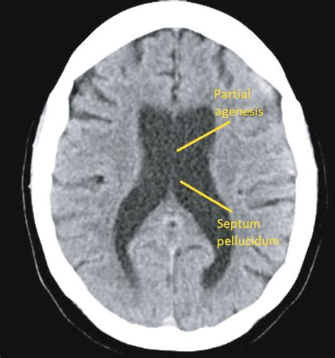 Septum Pellucidum Mri