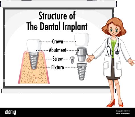 Infographic Of Human In Structure Of The Dental Implant Illustration