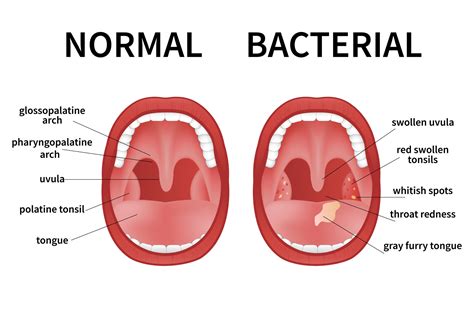 Bacterial And Viral Tonsillitis Angina Pharyngitis And Tonsillitis