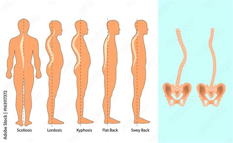 Spine Deformation Body Posture Defect Stock Vector Adobe Stock