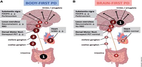 Two Types Of Parkinsons Disease Pathologies Body First Ver