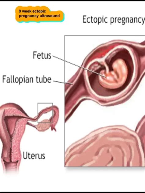 Vaginal Ultrasound Best Purpose Procedure And What To Expect 2023