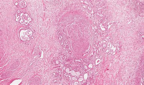 Cholangiocarcinoma Histology