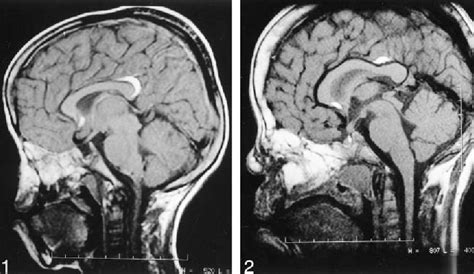 Figure From Multiple Pericallosal Lipomas In Two Siblings With