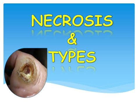 Necrosis and types | PPT