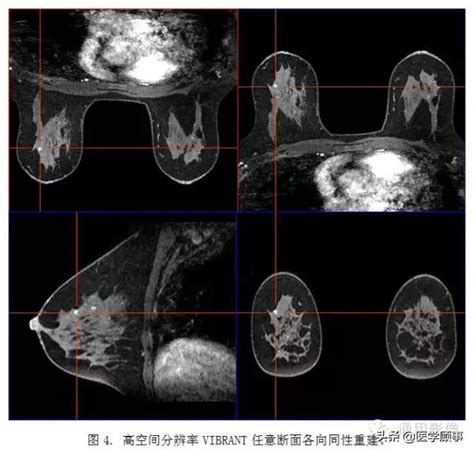 乳腺磁共振VIBRANT三维成像 乳腺 乳腺癌 恶性肿瘤 新浪新闻