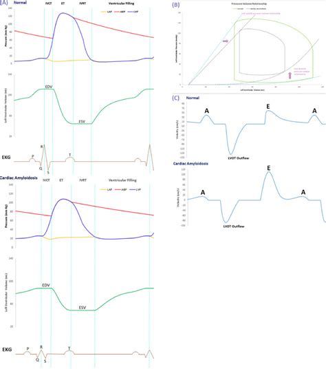 The Wiggers Diagram Hemodynamic Changes In Cardiac Amyloidosis