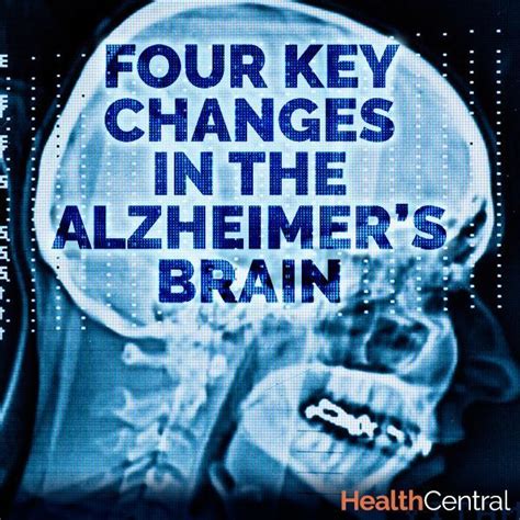 Four Key Changes in the Alzheimer’s Brain - Brain Scan - Alzheimer's | Alzheimer's brain ...