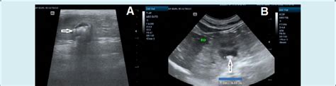 Abdominal Ultrasonography After Implantation Of The Subcutaneous